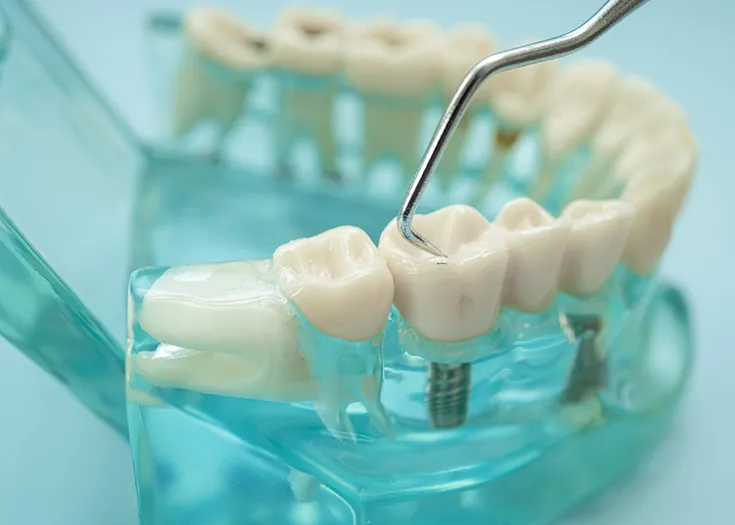 Ankara İmplant Fiyatları