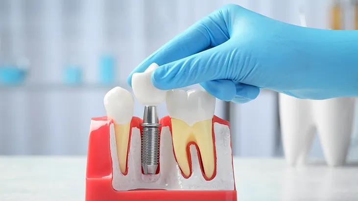 Ankara İmplant Fiyatları