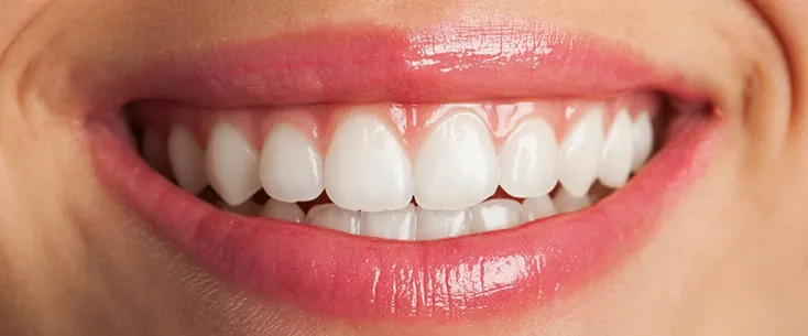 Diş Beyazlatma Yöntemleri